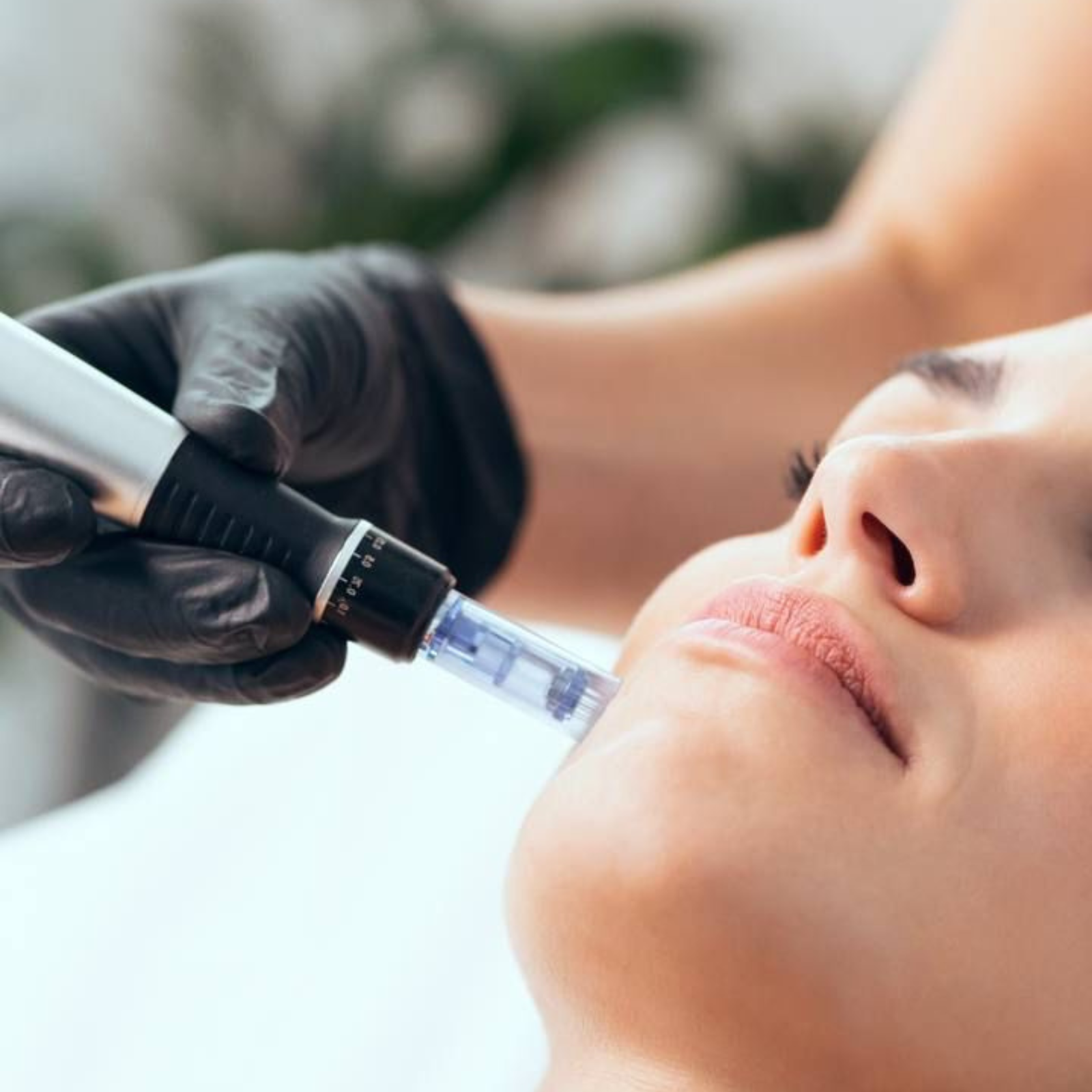 Person receiving a microneedling facial at Prolase